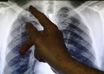 ಕರ್ನಾಟಕ : ಕೋವಿಡ್ ನಿಂದ ಚೇತರಿಸಿಕೊಂಡ 151 ರೋಗಿಗಳಲ್ಲಿ ಕ್ಷಯರೋಗ ಪತ್ತೆ