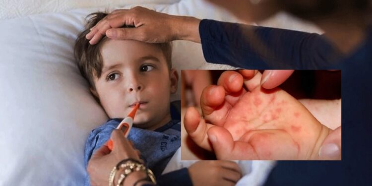 ಕೇರಳದಲ್ಲಿ ಪತ್ತೆಯಾದ ಟೊಮೇಟೋ ಜ್ವರ : ಯಾರಿಗೆ ತಗುಲುತ್ತದೆ? ಏನಿದರ ಗುಣ ಲಕ್ಷಣ?