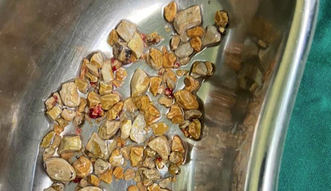 ಒಂದೇ ಗಂಟೆಯಲ್ಲಿ 206 ಕಿಡ್ನಿ ಸ್ಟೋನ್ ಹೊರತೆಗೆದ ವೈದ್ಯರು!