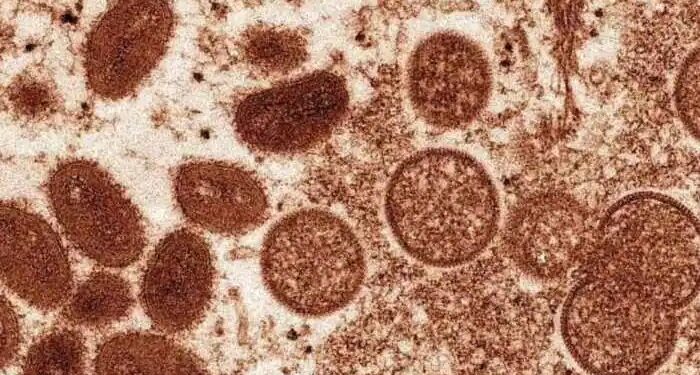 ಕೇರಳದಲ್ಲಿ ಮತ್ತೊಂದು ಮಂಕಿಪಾಕ್ಸ್ ಪ್ರಕರಣ ಪತ್ತೆ