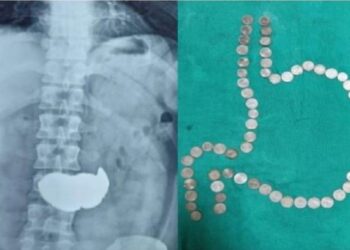 ‌1 ರೂಪಾಯಿಯ 63 ನಾಣ್ಯ ನುಂಗಿದ ಭೂಪ!