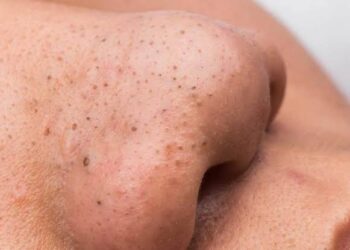 Blackheads-Natural remedie :ಬ್ಲಾಕ್ ಹೆಡ್ಸ್ ಗೆ ಇಲ್ಲಿದೆ ಶಾಶ್ವತ ಪರಿಹಾರ.!