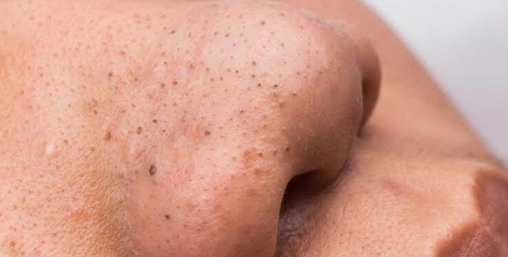 Blackheads-Natural remedie :ಬ್ಲಾಕ್ ಹೆಡ್ಸ್ ಗೆ ಇಲ್ಲಿದೆ ಶಾಶ್ವತ ಪರಿಹಾರ.!