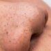 Blackheads-Natural remedie :ಬ್ಲಾಕ್ ಹೆಡ್ಸ್ ಗೆ ಇಲ್ಲಿದೆ ಶಾಶ್ವತ ಪರಿಹಾರ.!