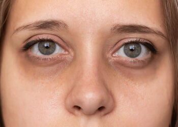 Dark circles: ಡಾರ್ಕ್ ಸರ್ಕಲ್ಸ್ ಜಾಸ್ತಿ ಇದ್ರೆ ಈ ರೆಮಿಡೀಸ್ ನ ಟ್ರೈ ಮಾಡಿ ಈ ಸಮಸ್ ಗೆ ಗುಡ್ ಬಾಯ್ ಹೇಳಿ.!