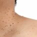 Skin tags: ನರಹುಲಿ ಸಮಸ್ಯೆಗೆ ಇಲ್ಲಿದೆ ಬೆಸ್ಟ್ ಪರಿಹಾರ.!