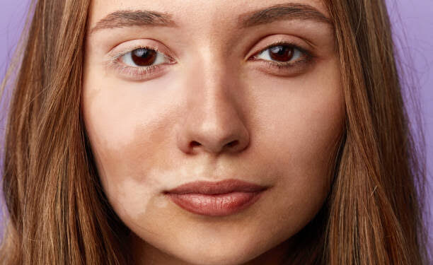 White patches: ಮುಖದಲ್ಲಿನ ಬಿಳಿ ಕಲೆಗಳ ಸಮಸ್ಯೆಗೆ ತಕ್ಷಣವೇ ಗುಡ್ ಬಾಯ್ ಹೇಳಿ.!