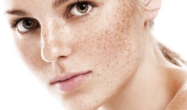 Pigmentation: ಮುಖದಲ್ಲಿ ಪಿಗ್ಮೆಂಟೇಷನ್ ಸಮಸ್ಯೆಯೇ? ಹಾಗಿದ್ರೆ ಈ ಮನೆಮದ್ದನ್ನು ಬಳಸಿ.!