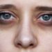 Dark circles: ಕಣ್ಣಿನ ಕೆಳಗೆ ಬರುವಂತಹ ಡಾರ್ಕ್ ಸರ್ಕಲ್ಸ್ ಗೆ ಪ್ರಮುಖ ಕಾರಣಗಳು ಇವೆ.!