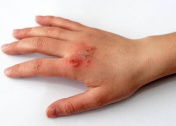 ಸುಟ್ಟು ಚಿಕ್ಕ ಪುಟ್ಟ ಗಾಯವಾದ್ರೆ ತಕ್ಷಣವೆ ಈ ಮನೆ ಮದ್ದನ್ನು ಬಳಸಿ.!