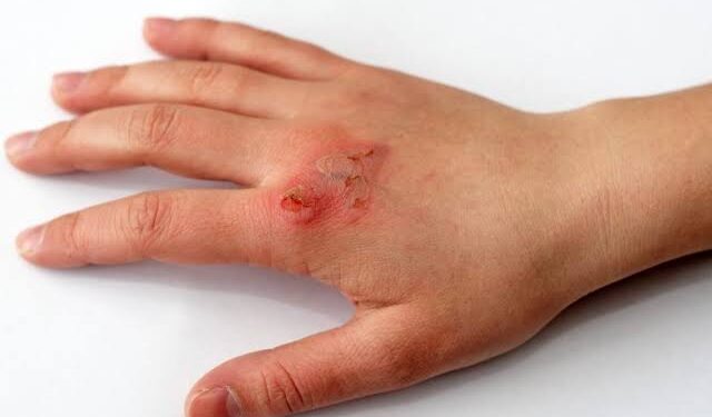 ಸುಟ್ಟು ಚಿಕ್ಕ ಪುಟ್ಟ ಗಾಯವಾದ್ರೆ ತಕ್ಷಣವೆ ಈ ಮನೆ ಮದ್ದನ್ನು ಬಳಸಿ.!