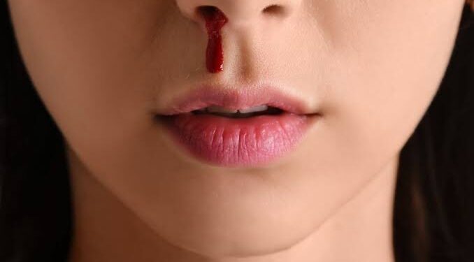 ಉಷ್ಣತೆ ಹೆಚ್ಚಾಗಿ ಮೂಗಿನಲ್ಲಿ ರಕ್ತಸ್ರಾವ ಆಗ್ತಾ ಇದ್ರೆ ಈ ಟಿಪ್ಸ್ ನ ಫಾಲೋ ಮಾಡಿ.!