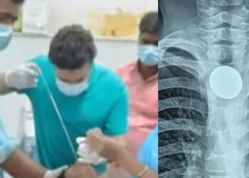 7 ವರ್ಷಗಳಿಂದ ಗಂಟಲಿನಲ್ಲಿ ಸಿಲುಕಿದ್ದ ನಾಣ್ಯ