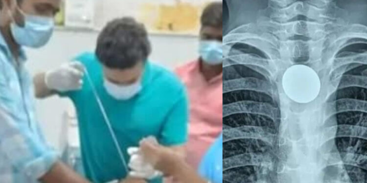 7 ವರ್ಷಗಳಿಂದ ಗಂಟಲಿನಲ್ಲಿ ಸಿಲುಕಿದ್ದ ನಾಣ್ಯ