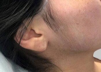 ನಿಮ್ಮ ತ್ವಚೆಯ ಕೂದಲನ್ನು ತೊಡೆದು ಹಾಕಲು ಈ ಫೇಸ್ ಪ್ಯಾಕ್ ಗಳನ್ನು ಬಳಸಿ.!