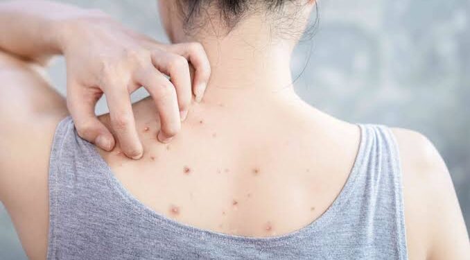 ಬೆನ್ನಿನ ಮೇಲೆ ಮೊಡವೆಗಳಾಗಿದ್ದರೆ, ಈ ಸಿಂಪಲ್ ಮನೆಮದ್ದುಗಳನ್ನ ಬಳಸಿ.!