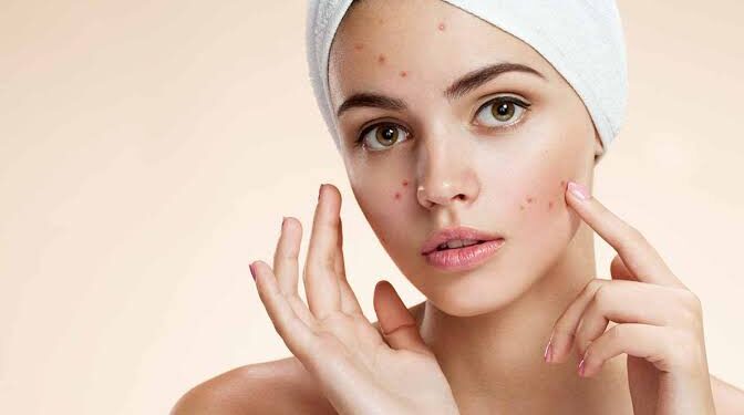 ಈ ಪದಾರ್ಥಗಳನ್ನ ಸೇವಿಸದಿದ್ದರೆ ಮುಖದಲ್ಲಿರುವ ಮೊಡವೆಗಳು ಕಡಿಮೆಯಾಗುತ್ತದೆ.!