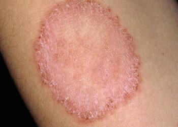 Best tips: ಹುಳುಕಡ್ಡಿ ದೇಹದಲ್ಲಾಗಲು ಕಾರಣಗಳು,ಯಾವ ಭಾಗದಲ್ಲಿ ಉಂಟಾಗುತ್ತದೆ ಮತ್ತು ಅದಕ್ಕೆ ಮನೆಮದ್ದುಗಳು ಯಾವುದು?