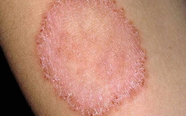 Best tips: ಹುಳುಕಡ್ಡಿ ದೇಹದಲ್ಲಾಗಲು ಕಾರಣಗಳು,ಯಾವ ಭಾಗದಲ್ಲಿ ಉಂಟಾಗುತ್ತದೆ ಮತ್ತು ಅದಕ್ಕೆ ಮನೆಮದ್ದುಗಳು ಯಾವುದು?