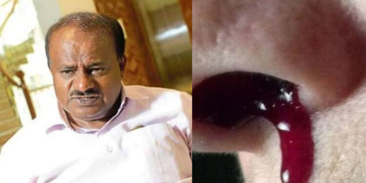 ಹೆಚ್.ಡಿ ಕುಮಾರಸ್ವಾಮಿ ಮೂಗಿನಲ್ಲಿ ಧಿಡೀರ್ ರಕ್ತಸ್ರಾವ ! ಕೆಲಕಾಲ ಮನೆಮಾಡಿದ್ದ ಆತಂಕ !