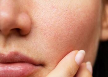 Skin care tips: ಓಪನ್ ಪೋರ್ಸ್ ನಿವಾರಣೆಗೆ ಈ ಮನೆ ಮದ್ದನ್ನು ಬಳಸಿ ತಕ್ಷಣಕ್ಕೆ ಪರಿಹಾರ ಪಡೆಯಿರಿ.!