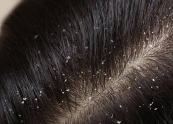 ಡ್ಯಾಂಡ್ರಫ್ ಸಮಸ್ಯೆಗೆ ಪ್ರಮುಖ ಕಾರಣಗಳು ಏನು ಗೊತ್ತಾ?