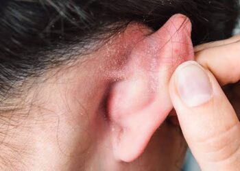 ಕಿವಿಯ ಭಾಗದಲ್ಲಾಗುವ ವೈಟ್ ಪ್ಯಾಚಸ್ಗೆ ಈ ಸಿಂಪಲ್ ಮನೆಮದ್ದನ್ನು ಬಳಸಿ.!