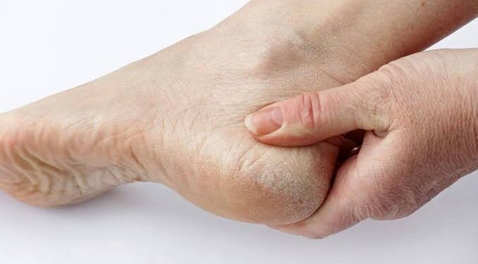 ಹೀಗೆ ಮಾಡುವುದರಿಂದ ಒಡೆದಿರುವ ಹಿಮ್ಮಡಿ ಬೇಗನೆ ಗುಣವಾಗುತ್ತದೆ.!