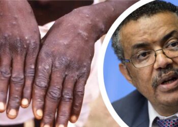 ಮಂಕಿಪಾಕ್ಸ್ ಏಕಾಏಕಿ ಅಂತರರಾಷ್ಟ್ರೀಯ ಕಾಳಜಿಯ ಸಾರ್ವಜನಿಕ ಆರೋಗ್ಯ ತುರ್ತುಸ್ಥಿತಿ ಎಂದು ಘೋಷಿಸಿದ:WHO