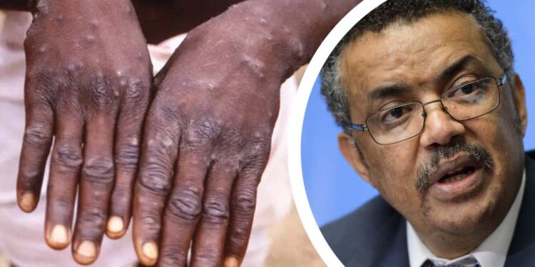 ಮಂಕಿಪಾಕ್ಸ್ ಏಕಾಏಕಿ ಅಂತರರಾಷ್ಟ್ರೀಯ ಕಾಳಜಿಯ ಸಾರ್ವಜನಿಕ ಆರೋಗ್ಯ ತುರ್ತುಸ್ಥಿತಿ ಎಂದು ಘೋಷಿಸಿದ:WHO