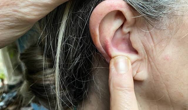 ಕಿವಿಯೊಳಗೆ ಮೊಡವೆಯಾದ್ರೆ ಈ ರೆಮಿಡಿನ ಟ್ರೈ ಮಾಡಿ.!