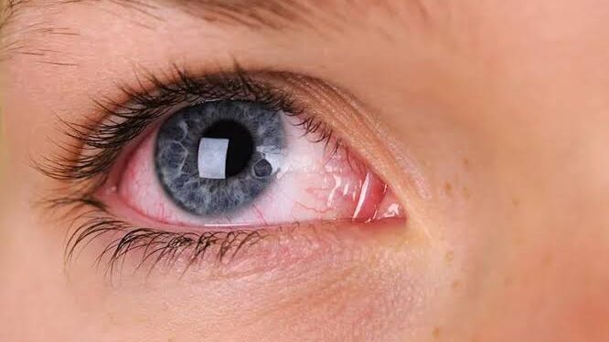 ಕಣ್ಣುಗಳಿಗೆ ಸ್ಟ್ರೆಸ್ ಹೆಚ್ಚಾದಾಗ, ಕಡಿಮೆ ಮಾಡಲು ಈ ಮನೆಮದ್ದುಗಳನ್ನು ಬಳಸಿ.!