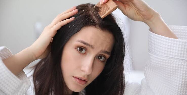 ಚಳಿಗಾಲದಲ್ಲಿ ಕಾಡುವ ಡ್ಯಾಂಡ್ರಫ್ ಸಮಸ್ಯೆಗೆ ಈ ಮನೆಮದ್ದು ಬಳಸಿ.!