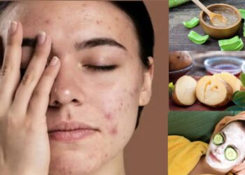 ಡಾರ್ಕ್ ಸ್ಪಾಟ್ಸ್  ಸಮಸ್ಯೆ ಹೆಚ್ಚಿದ್ದರೆ, ಈ ಸಿಂಪಲ್ ಮನೆ ಮದ್ದನ್ನು ಬಳಸಿ.!