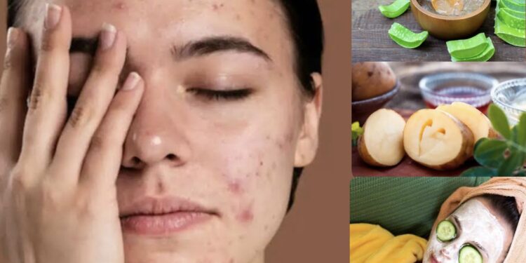 ಡಾರ್ಕ್ ಸ್ಪಾಟ್ಸ್  ಸಮಸ್ಯೆ ಹೆಚ್ಚಿದ್ದರೆ, ಈ ಸಿಂಪಲ್ ಮನೆ ಮದ್ದನ್ನು ಬಳಸಿ.!