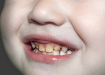 ಈ ತಪ್ಪುಗಳಿಂದಲೇ ಮಕ್ಕಳ ಹಲ್ಲುಗಳು ಹಳದಿಯಾಗುತ್ತದೆ.!